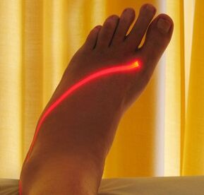 Laserbehandlung von Krampfadern an den Beinen