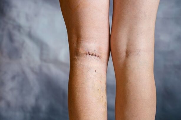 Naht am Bein nach der Operation bei Krampfadern