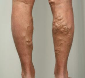 Lymphknoten in den Beinen mit Krampfadern