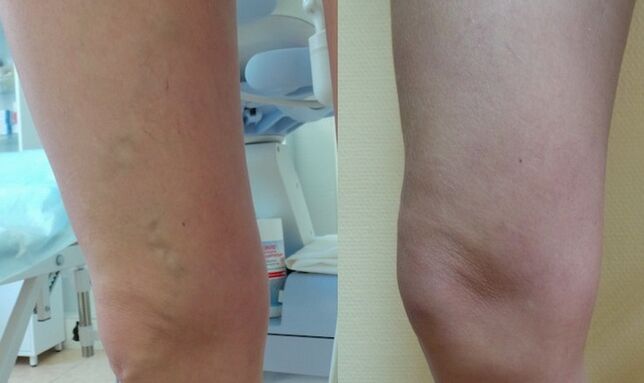 Bein vor und nach der Behandlung von retikulären Krampfadern
