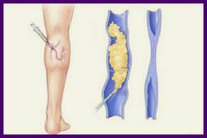 Die Sklerotherapie ist eine beliebte Methode, um Krampfadern an den Beinen loszuwerden. 
