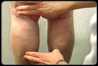Der Arzt untersucht die Beine mit Krampfadern