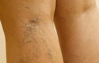 Behandlung von Krampfadern an den Beinen