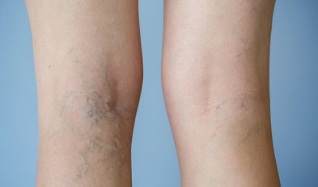 Anzeichen von Krampfadern an den Beinen bei Frauen