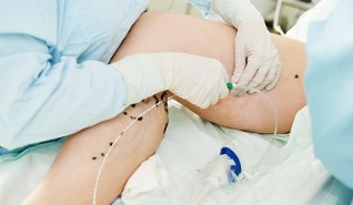 Methoden zur Behandlung von Krampfadern in den Beinen bei Frauen